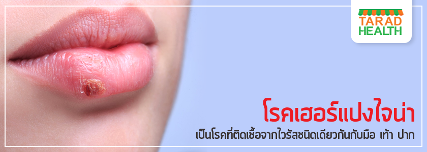 โรคเฮอร์แปงไจน่า หรือ โรคตุ่มแผลในปากเด็ก